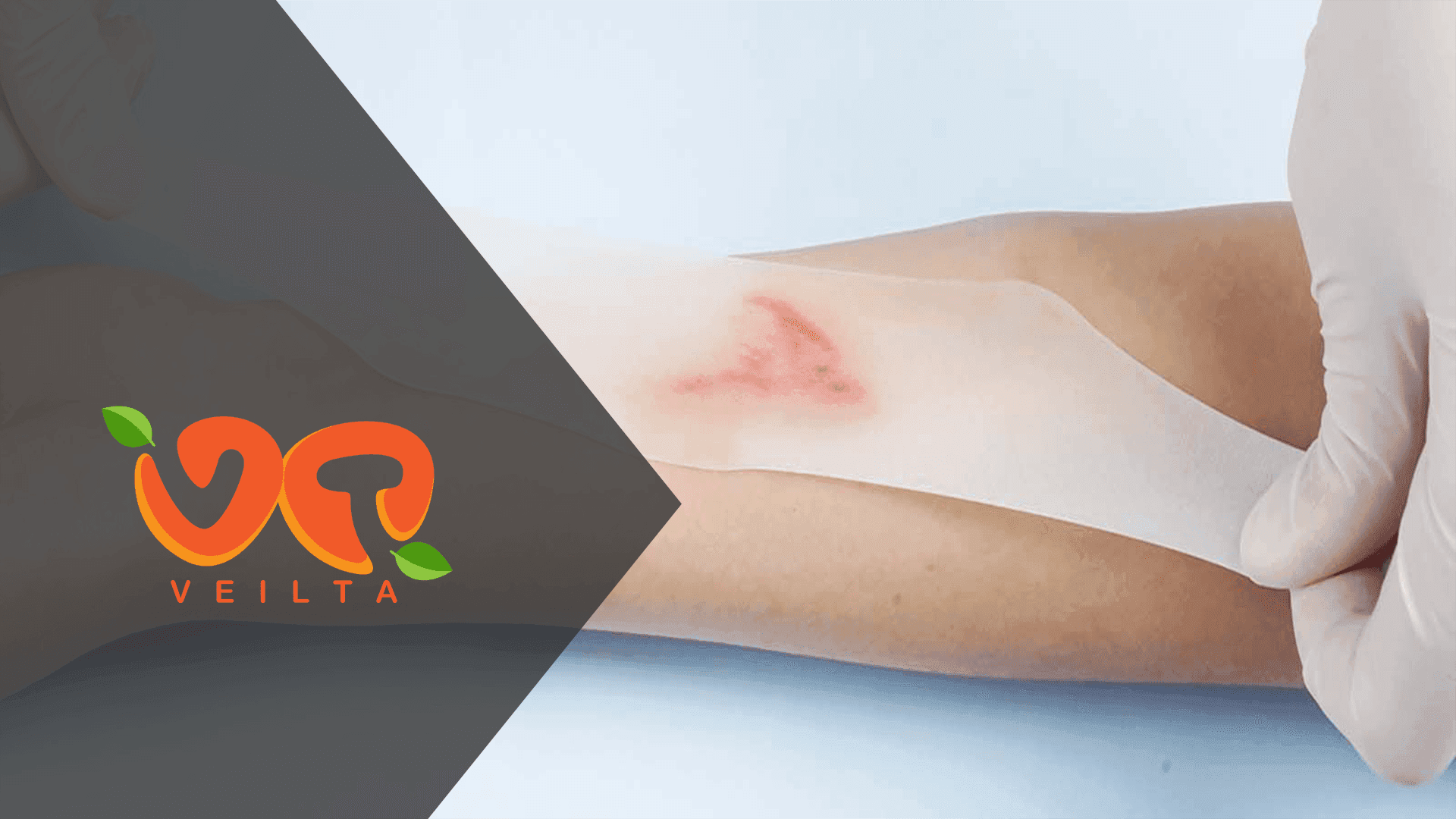 Does Hydrocolloid Help Scars? A Complete Healing Guide