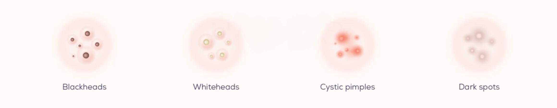 Four blemish types side by side — whitehead, blind pimple, papule, blackhead — with the recommended patch type labeled for each